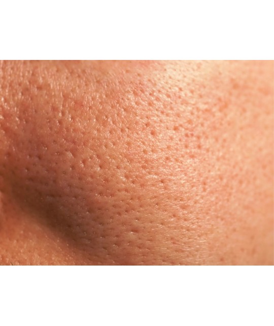Pores dilatés : quelles sont les causes et quelles sont les solutions ?